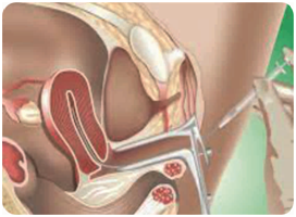 IUI treatment in Gurgaon, Infertility Specialist in Gurgaon